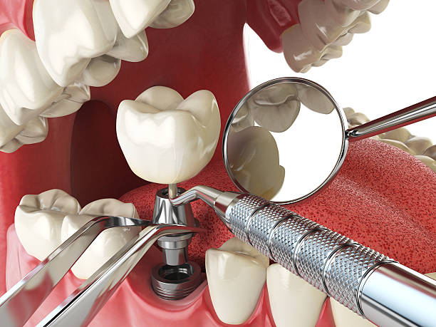 Best Emergency Treatment for Toothache in Jonestown, TX